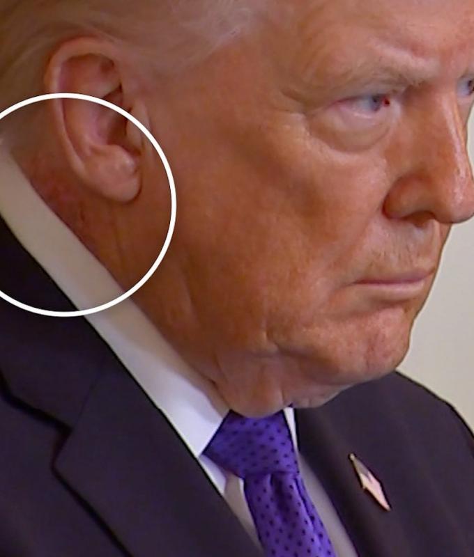 متابعة: ظهور طفح جلدي جديد على رقبة ترامب.. وتساؤلات بشأن حالته الصحية