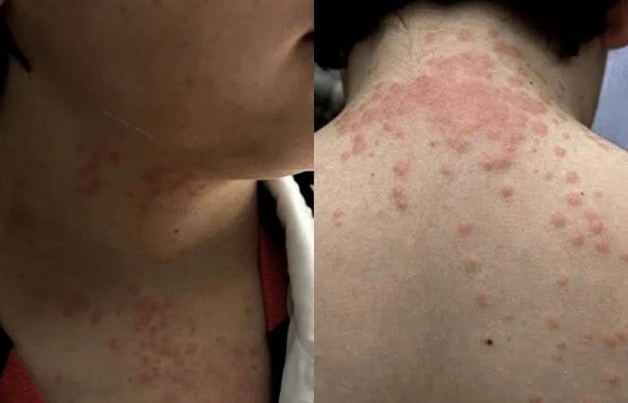 Family
      sues
      airlines
      after
      bed
      bug
      swarming
      on
      Europe-bound
      flight:
      'UNRELENTING
      ITCHY
      FEELING'