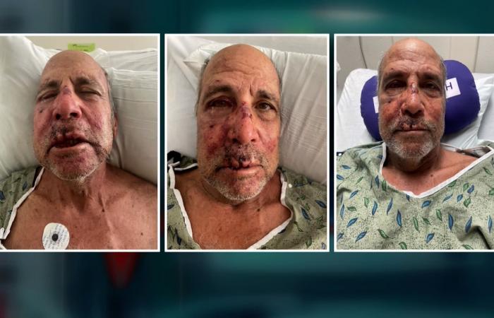 يكافح ورمًا دماغيًا معظم حياته.. مسن يتعرض لضرب مبرح يتركه بإصابات بالغة في الرأس وكسور متعددة