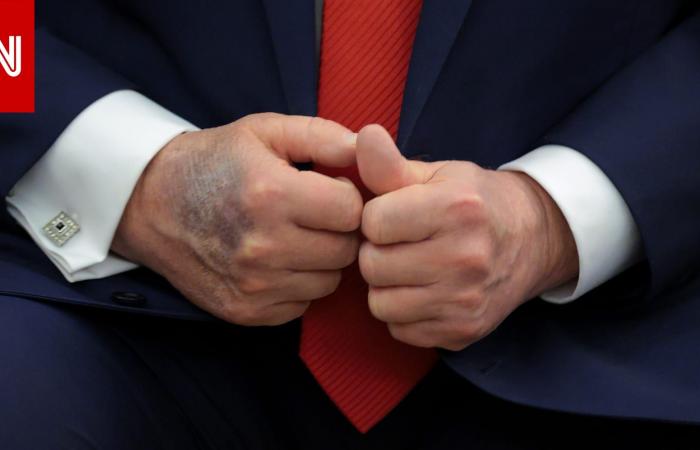 متابعة: صحة ترامب.. لماذا تثير كدمات يد الرئيس الأمريكي الأكبر سناً التساؤلات؟