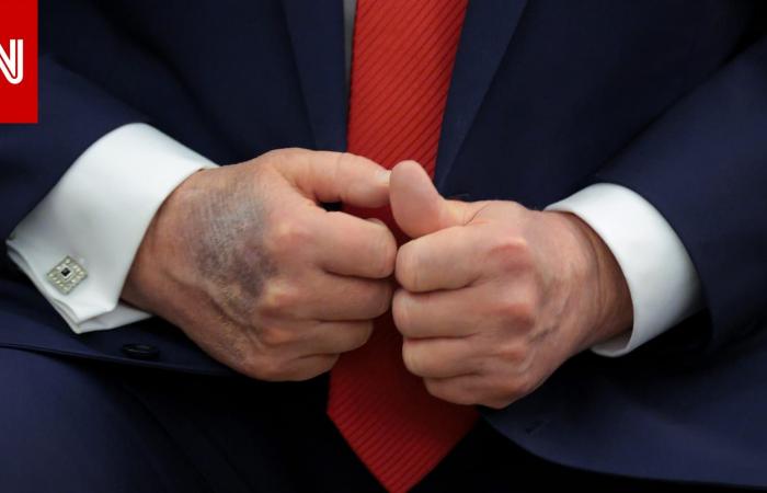 متابعة: ترامب لـ"وول ستريت جورنال" عن كدمات يده: أريد "دماً لطيفاً ورقيقاً يتدفق عبر قلبي"