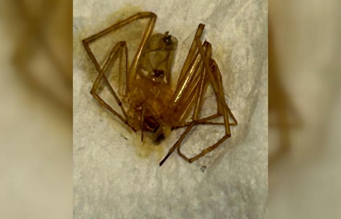 بسبب عضة عنكبوت.. سيدة تضطر لبتر أصابعها بعد تعرضها لعدوى خطيرة