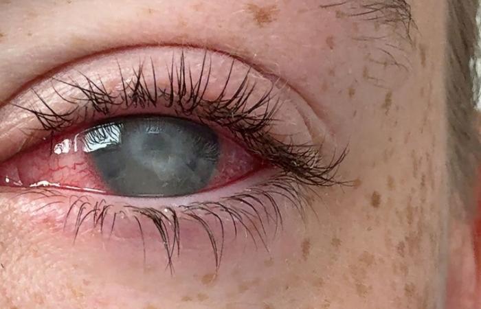 مرض طفيلي يسبب العمى لمستخدمي العدسات اللاصقة.. كيف تتجنبه؟