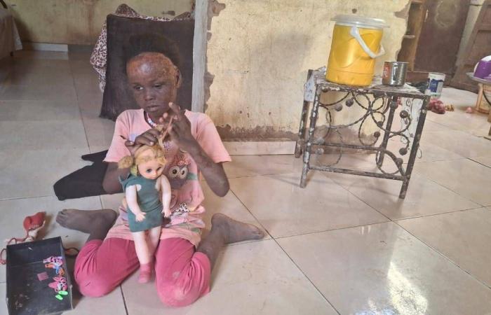 الحرب
      تحصد
      أطراف
      مئات
      الأطفال
      في
      السودان