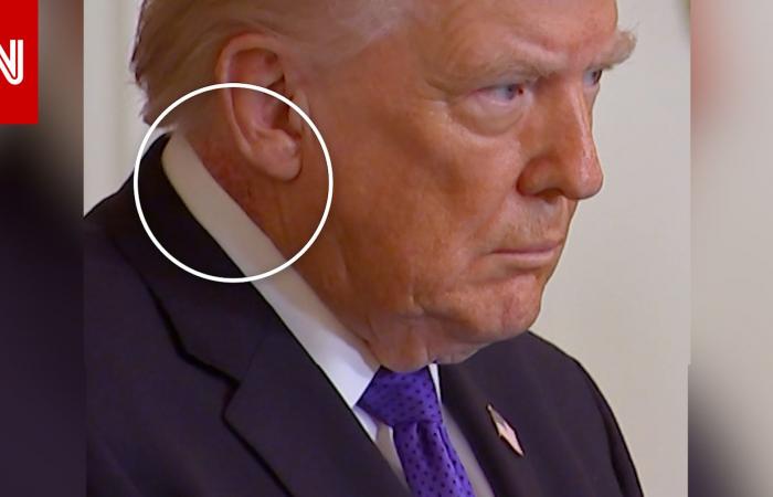 متابعة: ظهور طفح جلدي جديد على رقبة ترامب.. وتساؤلات بشأن حالته الصحية