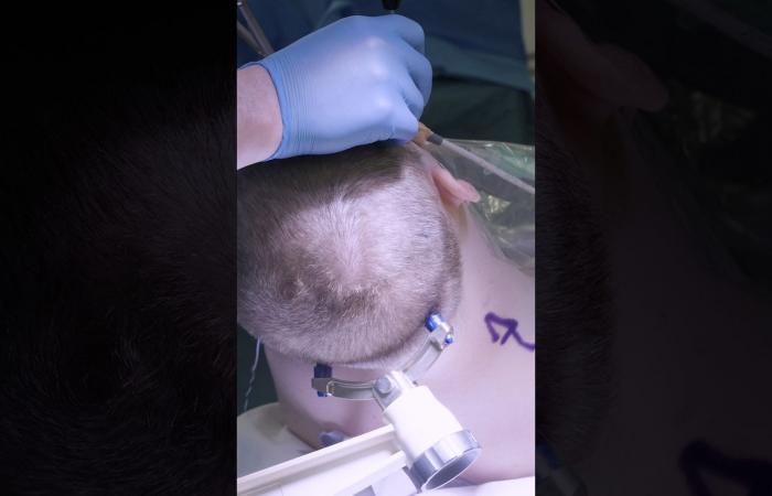 نظرة نادرة داخل عملية جراحية لمريض سرطان يتبرع بجزء من دماغه