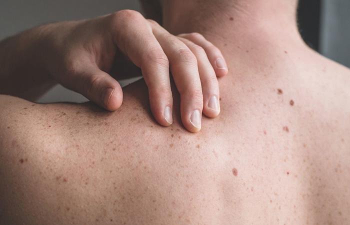 حروق الوجه والجسم..ما أسبابها وكيفية علاجها في المنزل؟