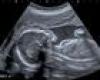 Soot particles present in the organs of unborn babies, research shows